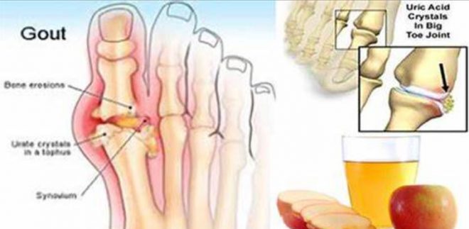 Uric acid and joints pain